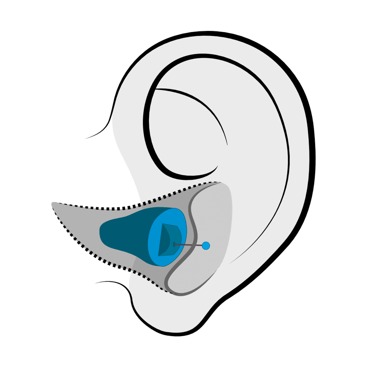 Invisible-in-canal (IIC) hearing aid style fitted at The Hearing Place in Falconer, NY